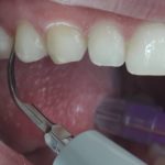Professzionális szájhigiéniás kezelés - Hermesz Dental