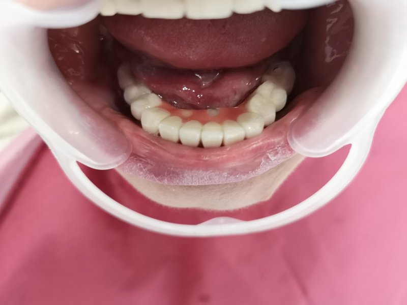 All-on-4 technik - Hermesz Dental Zahnklinik