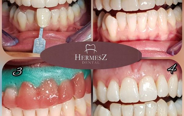 Fogfehérítés - Hermesz Dental Sopron