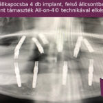 Alsó és felső implant röntgen